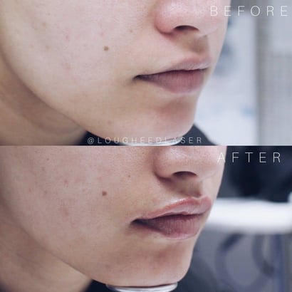 before and after fillers lip