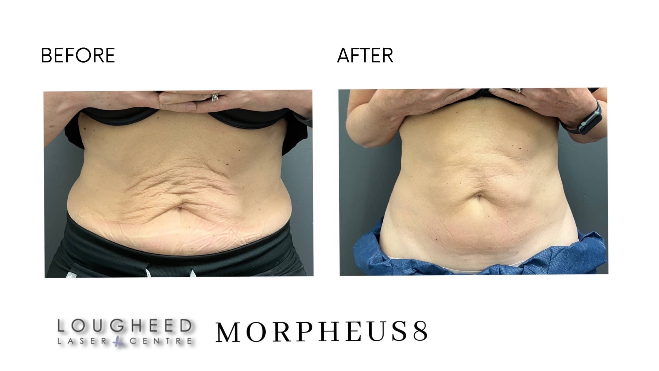 before and after morpheus8 - 3