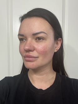 before and after vbeam treatment-1