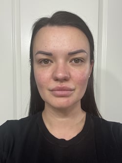 before and after vbeam treatment-2