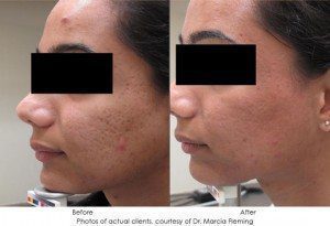 fraxel laser treatment before and after