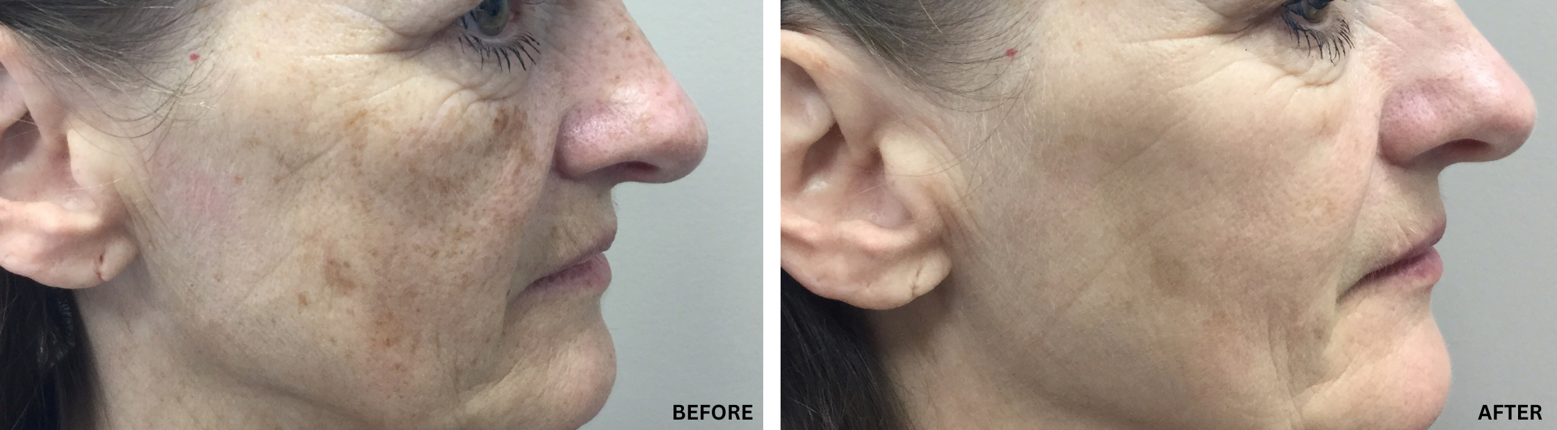 ipl laser before and after