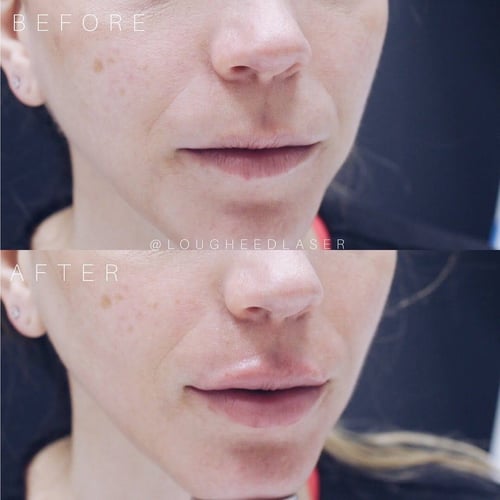 lougheed lip filler before after