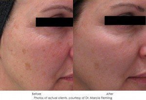 Collage of before and after photos showcasing the results of photorejuvenation treatments