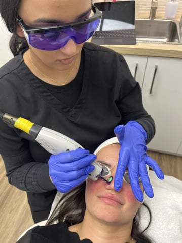 vbeam treatment procedure